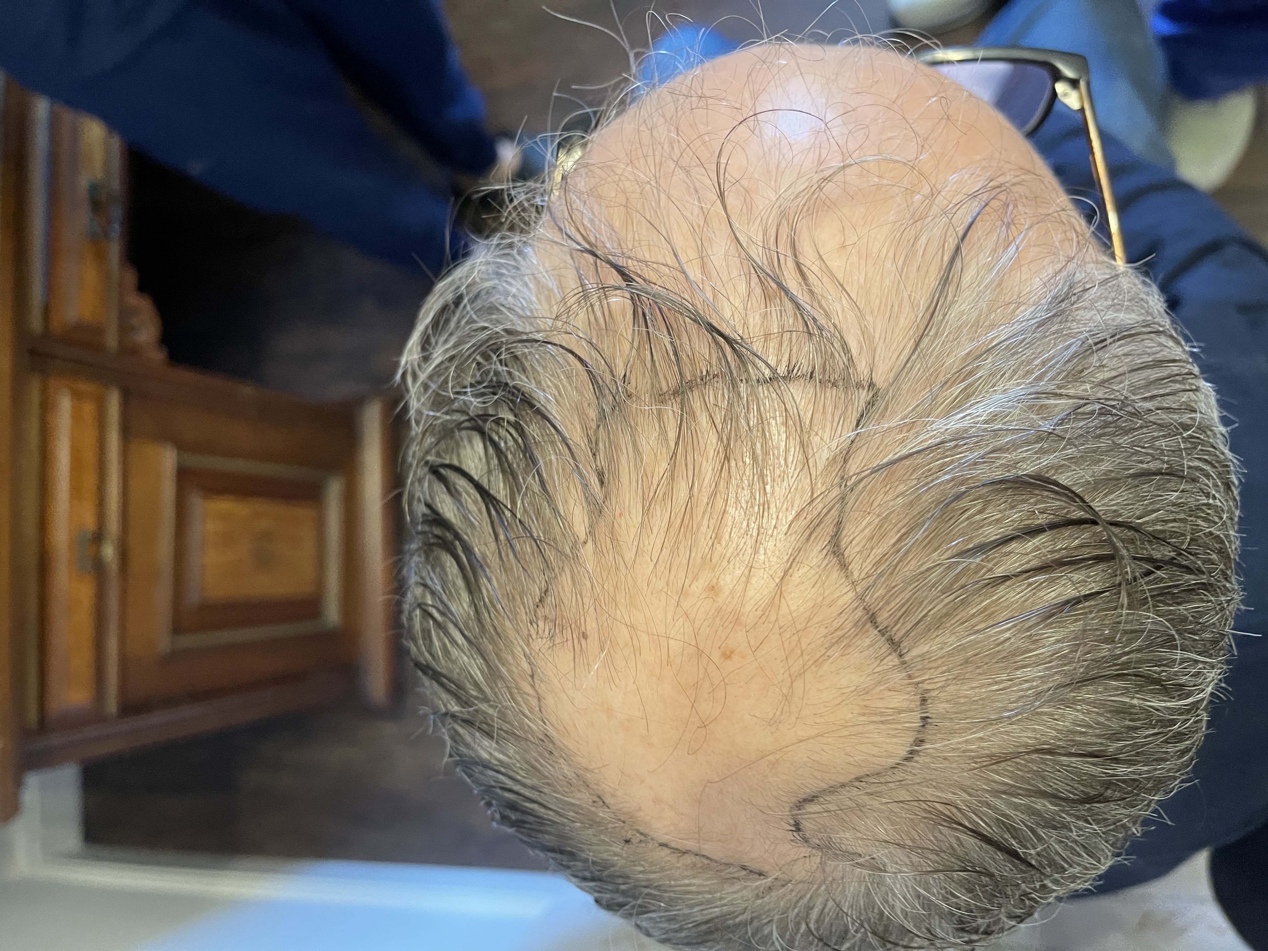 Norwood 7 hair transplant — Colin result photo 3